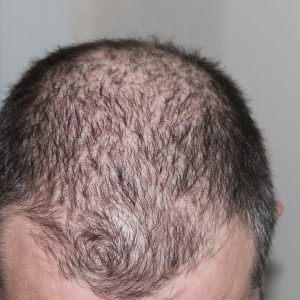 hair, man, hair loss, head, hair loss, hair loss, hair loss, hair loss, hair loss